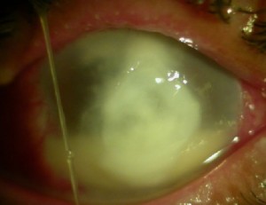 corneal-surgery-1