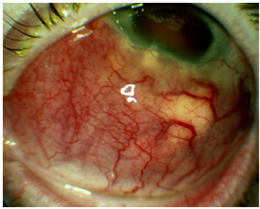 Scleritisis when any part of the sclera is inflamed.
