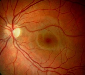 Healthy macula