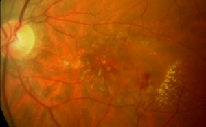 Wet AMD showing drusen blood leaking from new blood vessels under the macula.
