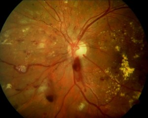 Retina with new blood vessels
and many patches of poor blood flow and hemorrhages