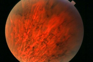 While retinitis pigmentosa can not be cured, it can be slowed down. It also affects how other eye problems are managed, so proper diagnosis and expert care are important.