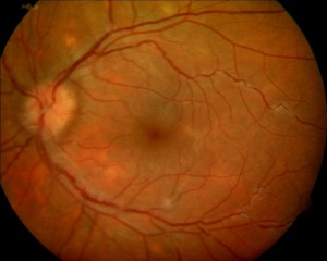 ICG study and color photograph of the same eye.