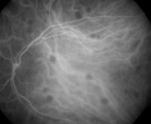 The ICG shows choroidal spots that are very difficult to see in the color photograph.