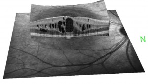 Scan of the retina showing how OCT can image this structure
