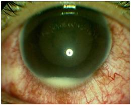 Uveitis can be caused by infection (germs) in the eye.