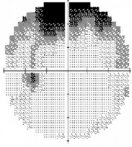 Visual Fields (VF)